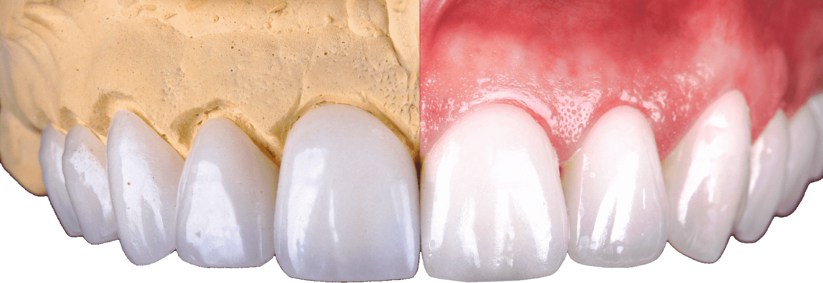 https://www.luxursmiles.com/wp-content/uploads/2024/05/luxur-smile-resin-porcelain-veneers.png